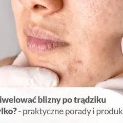 Zbliżenie na twarz z widocznymi bliznami po trądziku. Dłoń w białej rękawiczce delikatnie dotyka policzka, wskazując na niedoskonałości.