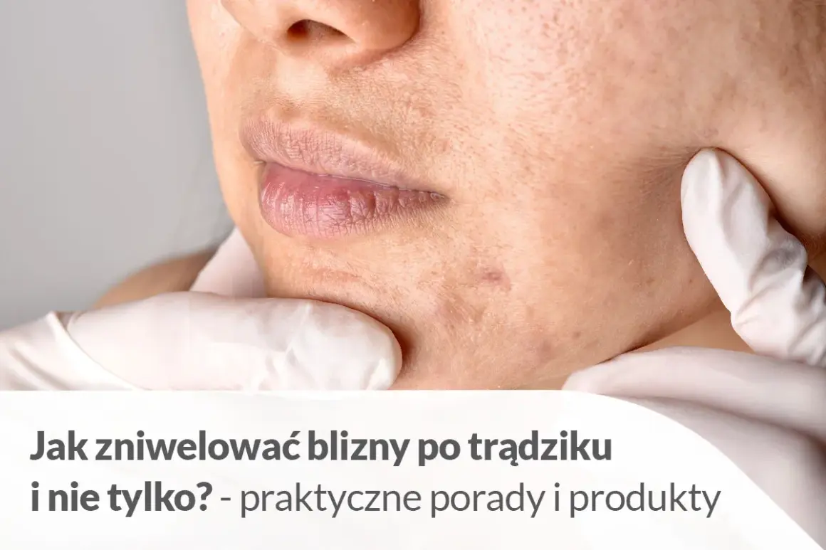 Zbliżenie na twarz z widocznymi bliznami po trądziku. Dłoń w białej rękawiczce delikatnie dotyka policzka, wskazując na niedoskonałości.