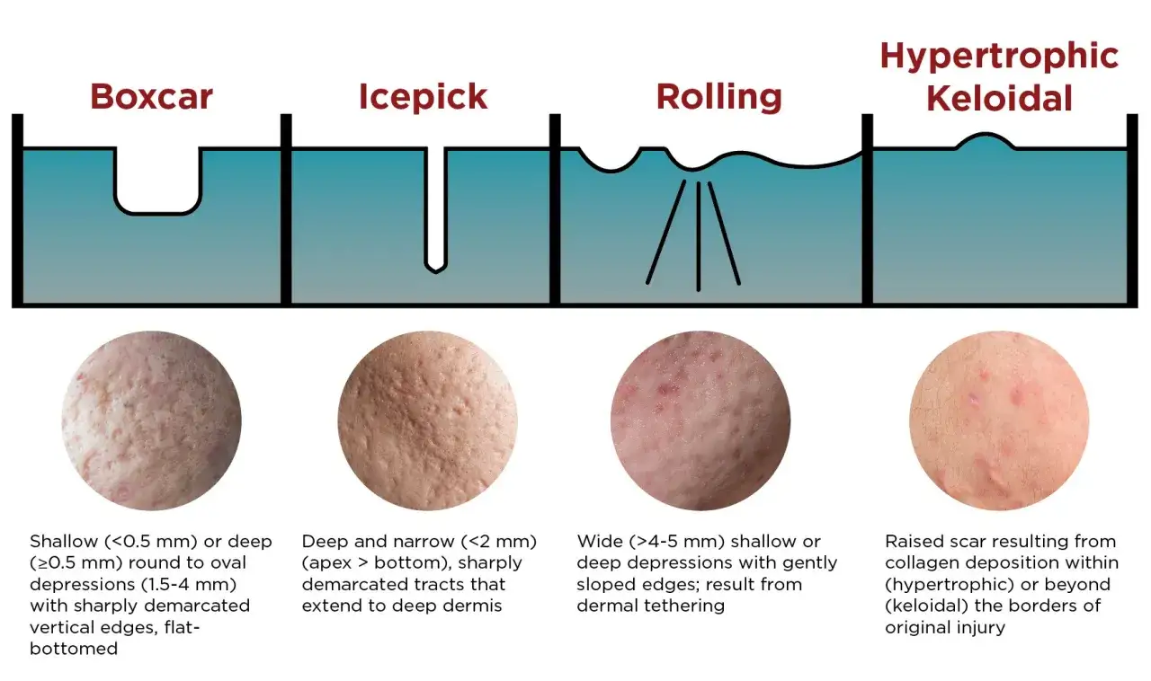 Różne rodzaje blizn po trądziku: wklęsłe (boxcar, icepick, rolling) i wypukłe (hipertroficzne, keloidalne).