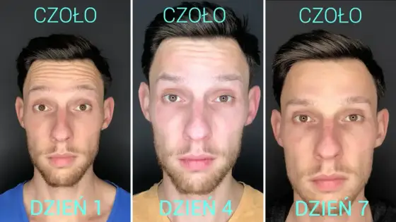 Więcej zmarszczek po botoksie? Dlaczego i co robić?